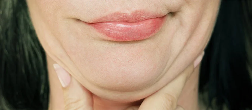 What Causes a Double Chin: Causes & Treatment Options