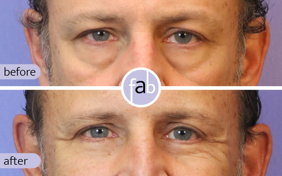 lower-eyelid-procedure-beauty